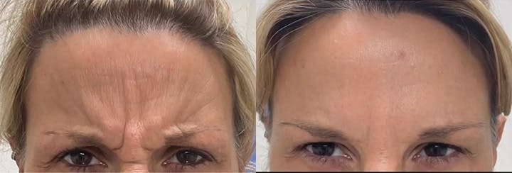 BOTOX Before & After Gallery - Patient 187063738 - Image 1