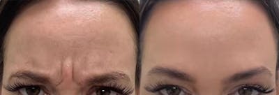 BOTOX Before & After Gallery - Patient 187063752 - Image 1