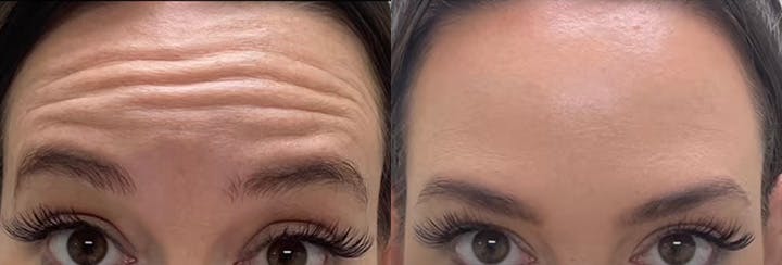 BOTOX Before & After Gallery - Patient 187063752 - Image 2