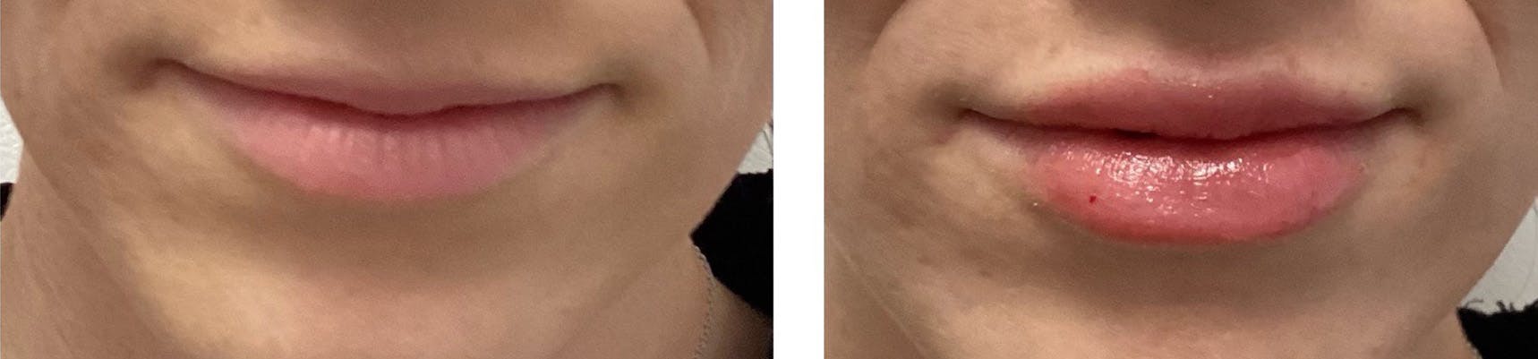 Lip Fillers Before & After Gallery - Patient 188992022 - Image 1