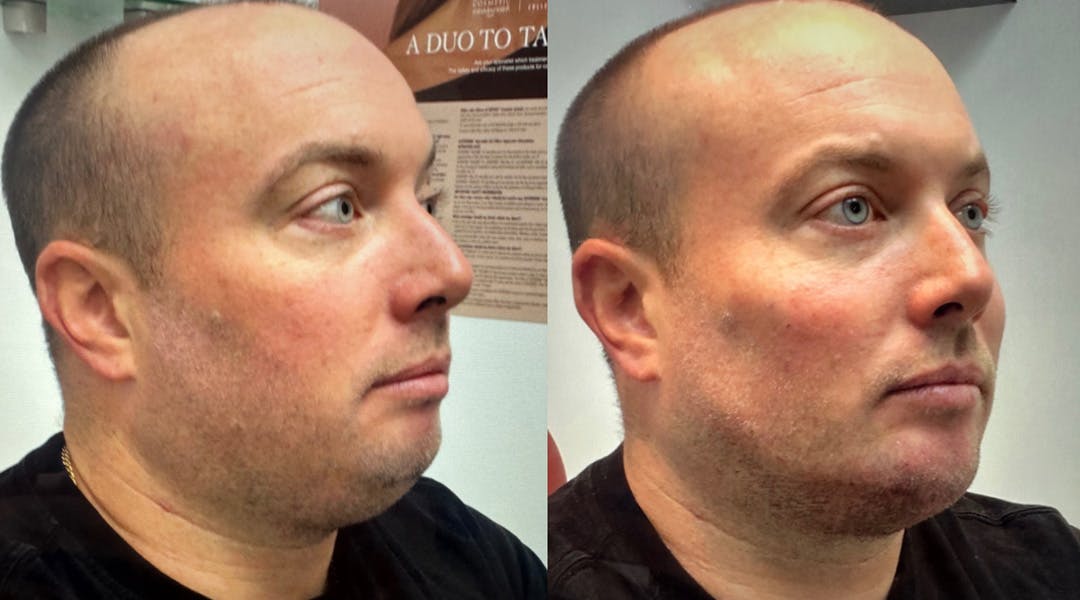 Liquid Chin & Jaw Contouring Before & After Gallery - Patient 359263 - Image 1