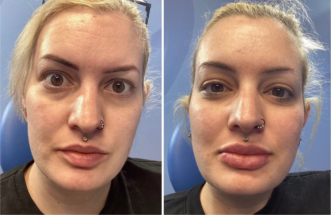 Lip Fillers Before & After Gallery - Patient 351771 - Image 1