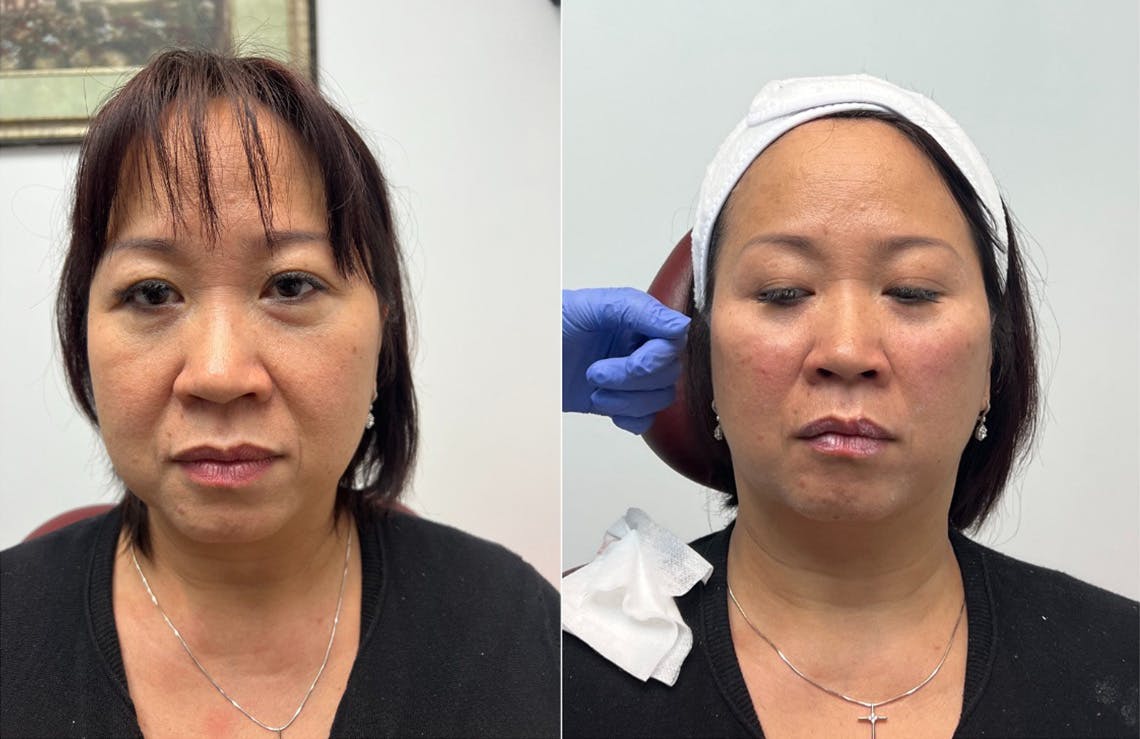 Lip Fillers Before & After Gallery - Patient 246977 - Image 1