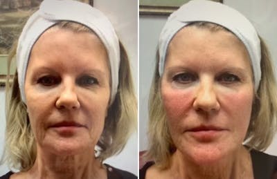 Liquid (Non-Surgical) Facelift Before & After Gallery - Patient 268709 - Image 1