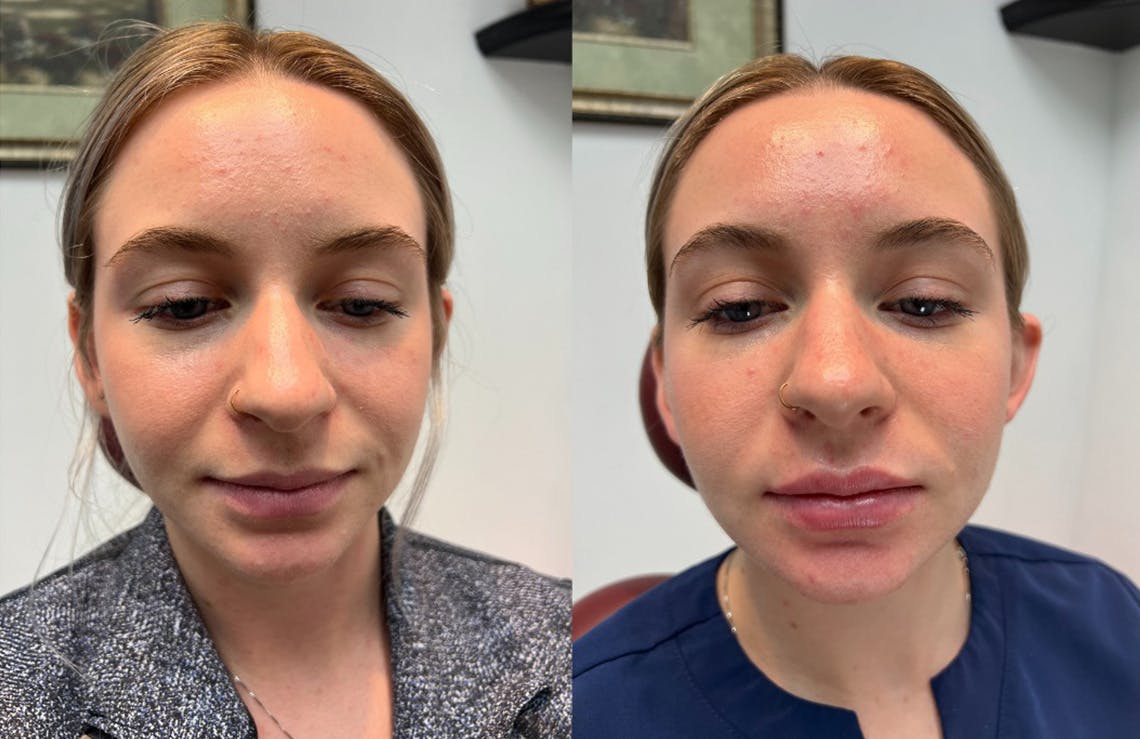 Lip Fillers Before & After Gallery - Patient 416674 - Image 1