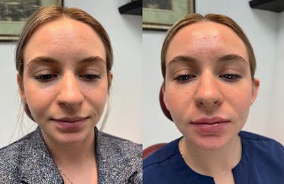Lip Fillers Before & After Gallery - Patient 416674 - Image 1
