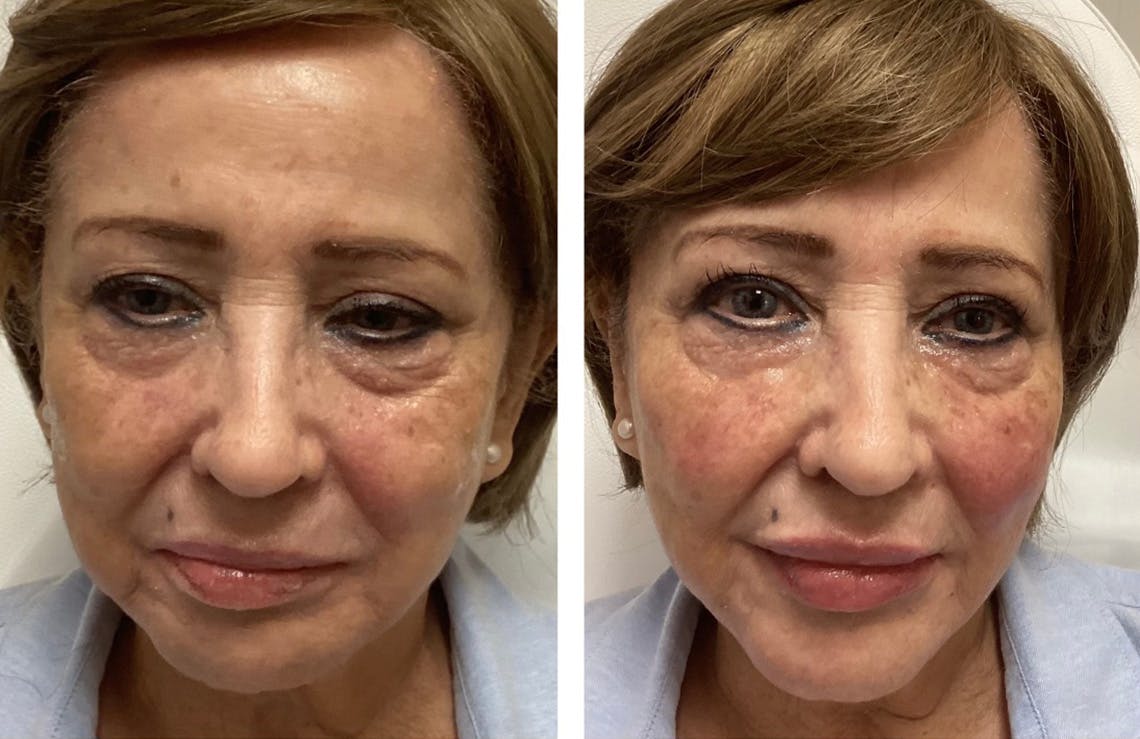 Liquid (Non-Surgical) Facelift Before & After Gallery - Patient 197985 - Image 1