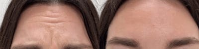 BOTOX Before & After Gallery - Patient 872448 - Image 1