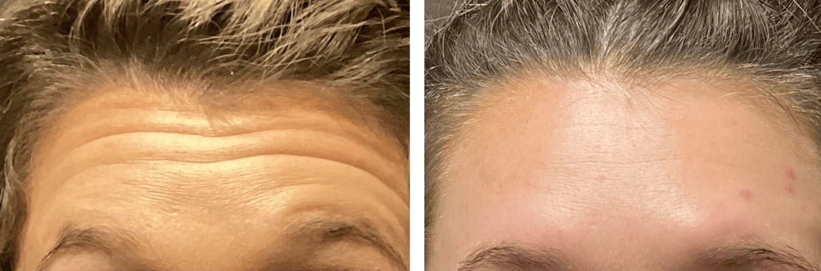 BOTOX Before & After Gallery - Patient 295170 - Image 1