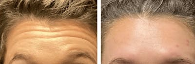 BOTOX Before & After Gallery - Patient 295170 - Image 1