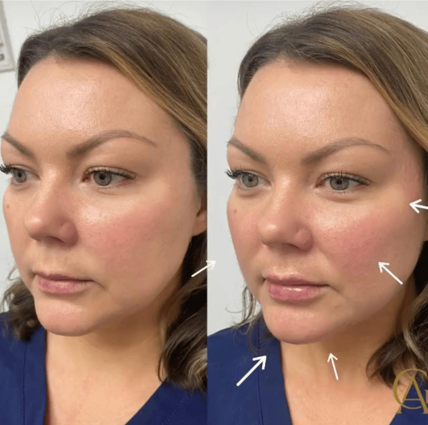 Cheek Contour Before & After Gallery - Patient 243908 - Image 1