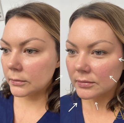 Cheek Contour Before & After Gallery - Patient 243908 - Image 1