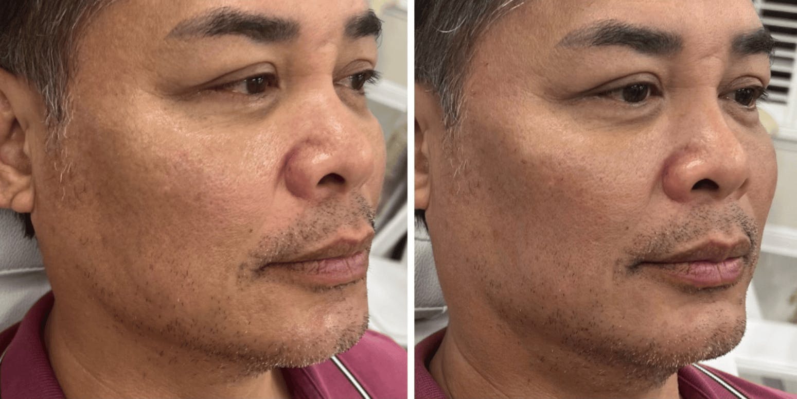 Liquid Chin & Jaw Contouring Before & After Gallery - Patient 699530 - Image 1