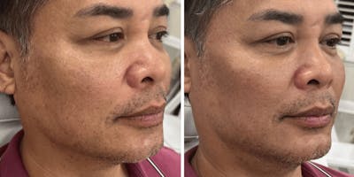 Liquid Chin & Jaw Contouring Before & After Gallery - Patient 699530 - Image 1