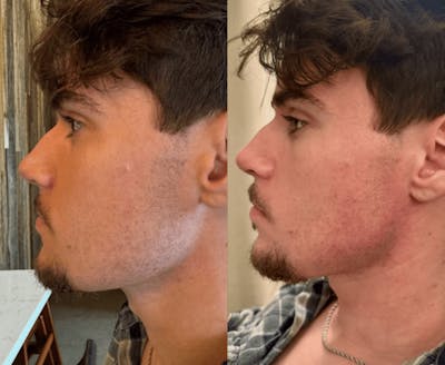 Liquid Chin & Jaw Contouring Before & After Gallery - Patient 420921 - Image 1