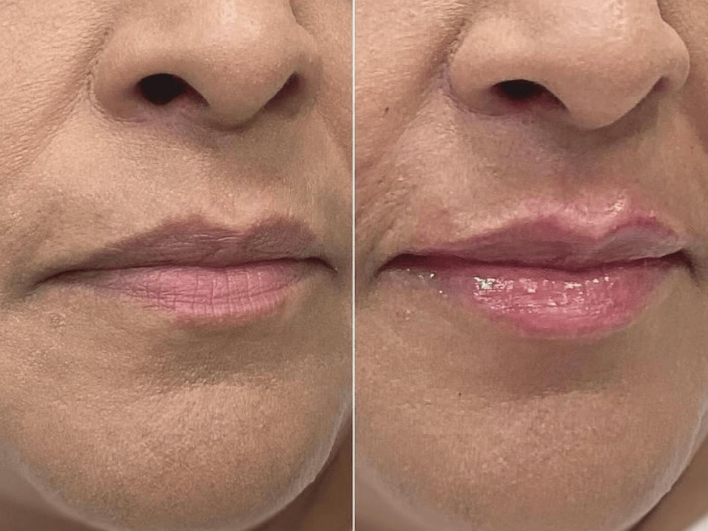 Lip Fillers Before & After Gallery - Patient 574663 - Image 1