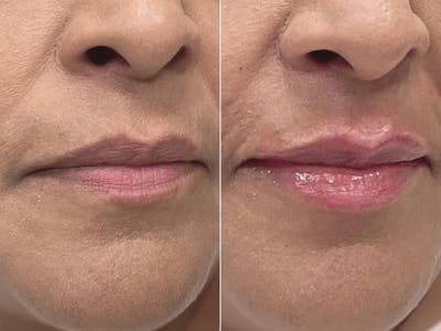 Lip Fillers Before & After Gallery - Patient 574663 - Image 1