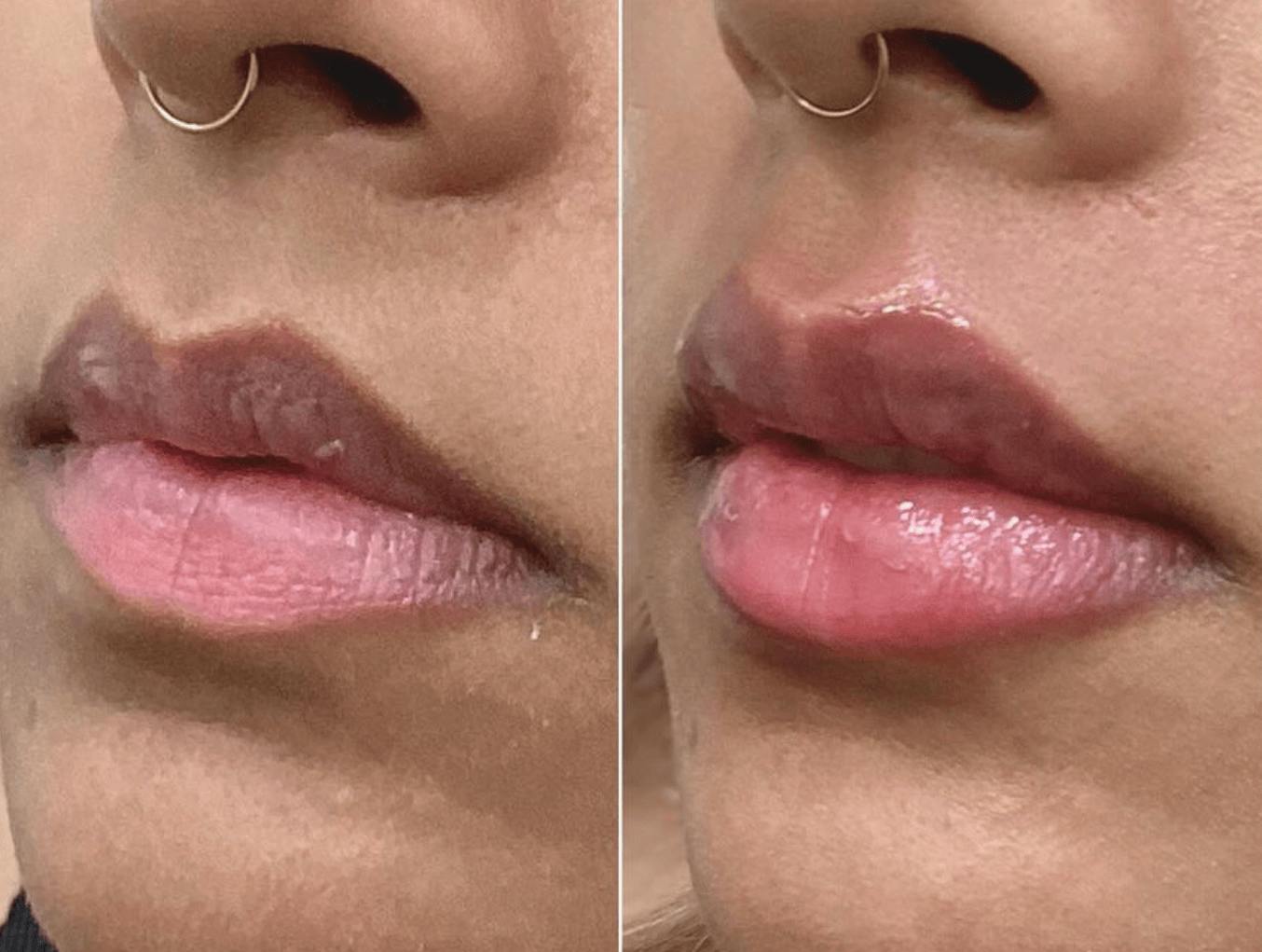 Lip Fillers Before & After Gallery - Patient 250138 - Image 1
