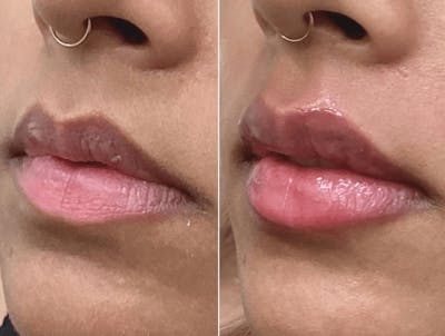 Lip Fillers Before & After Gallery - Patient 250138 - Image 1