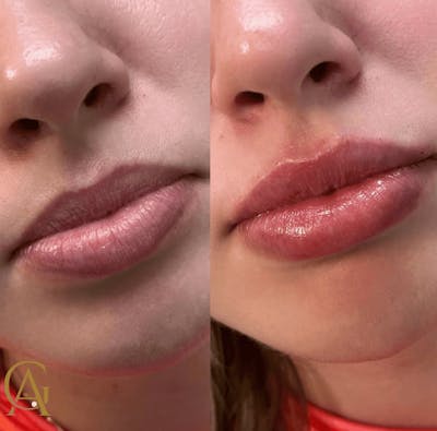 Lip Fillers Before & After Gallery - Patient 710517 - Image 1