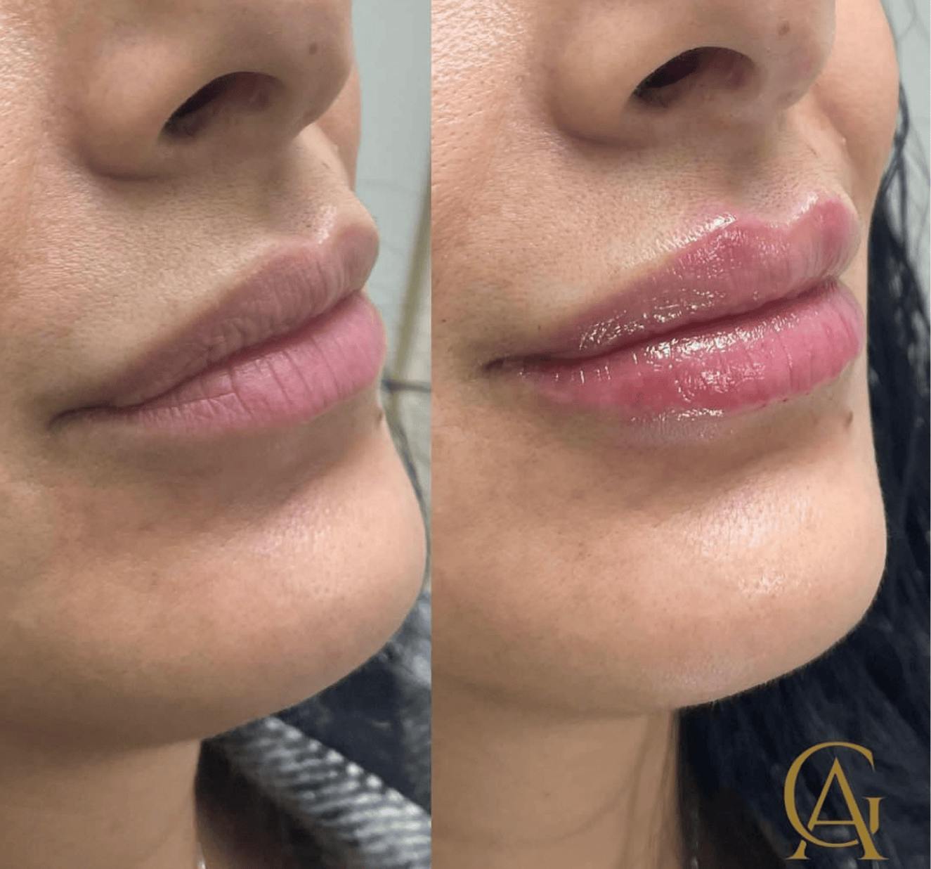 Lip Fillers Before & After Gallery - Patient 134116 - Image 1