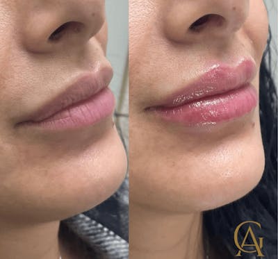 Lip Fillers Before & After Gallery - Patient 134116 - Image 1
