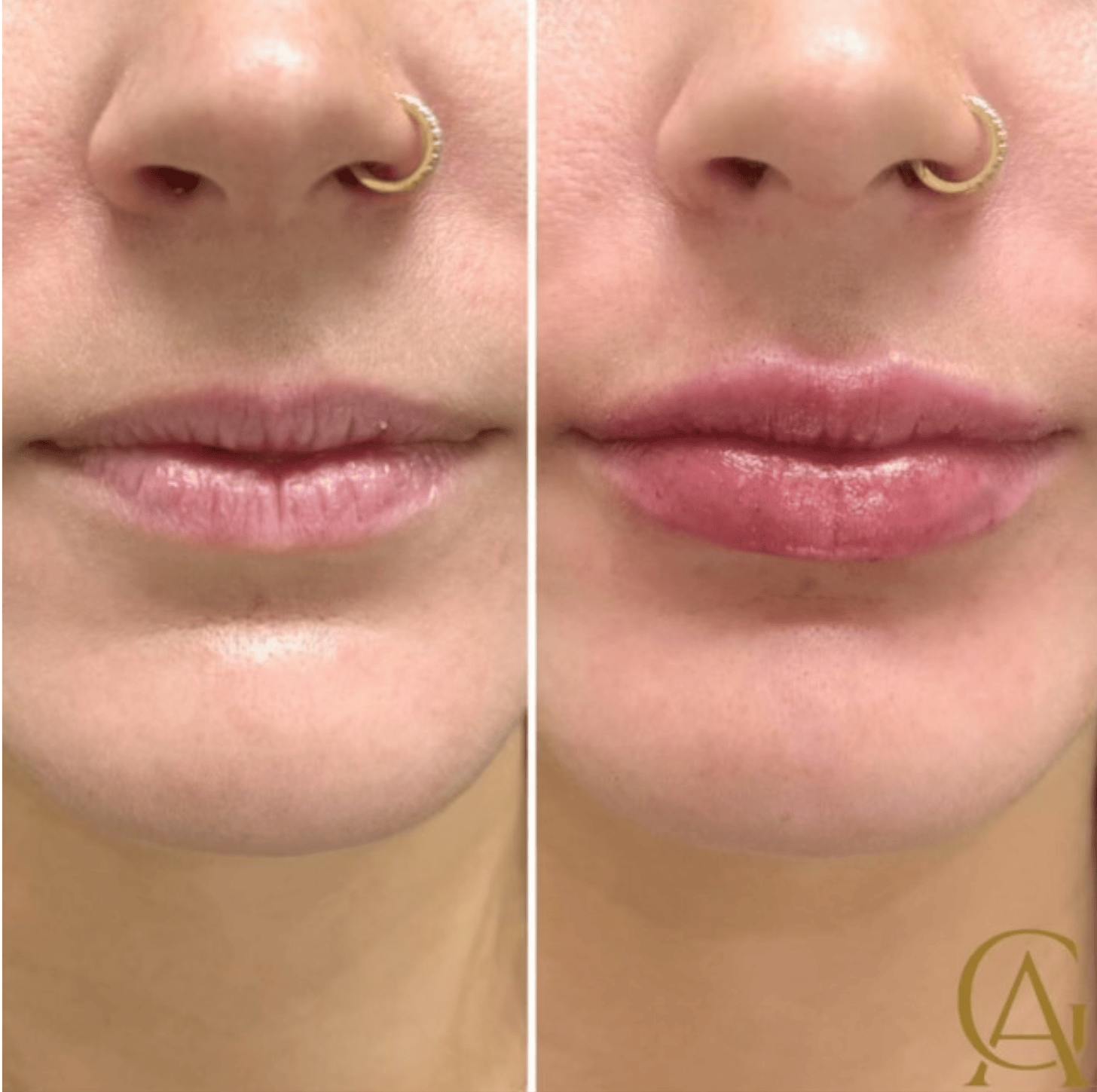 Lip Fillers Before & After Gallery - Patient 335871 - Image 1