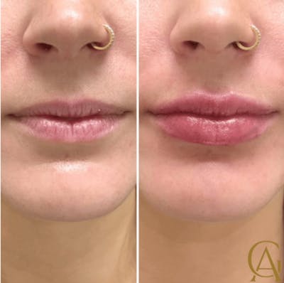 Lip Fillers Before & After Gallery - Patient 335871 - Image 1