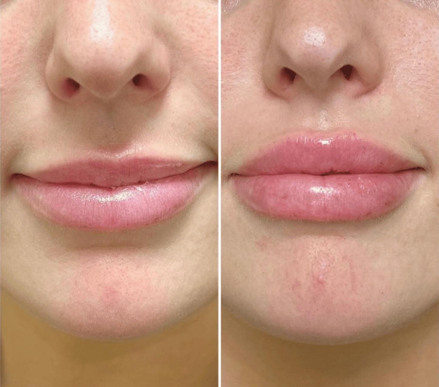 Lip Fillers Before & After Gallery - Patient 658693 - Image 1