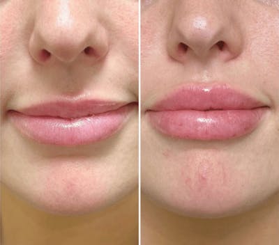 Lip Fillers Before & After Gallery - Patient 658693 - Image 1