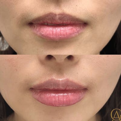 Lip Fillers Before & After Gallery - Patient 370320 - Image 1