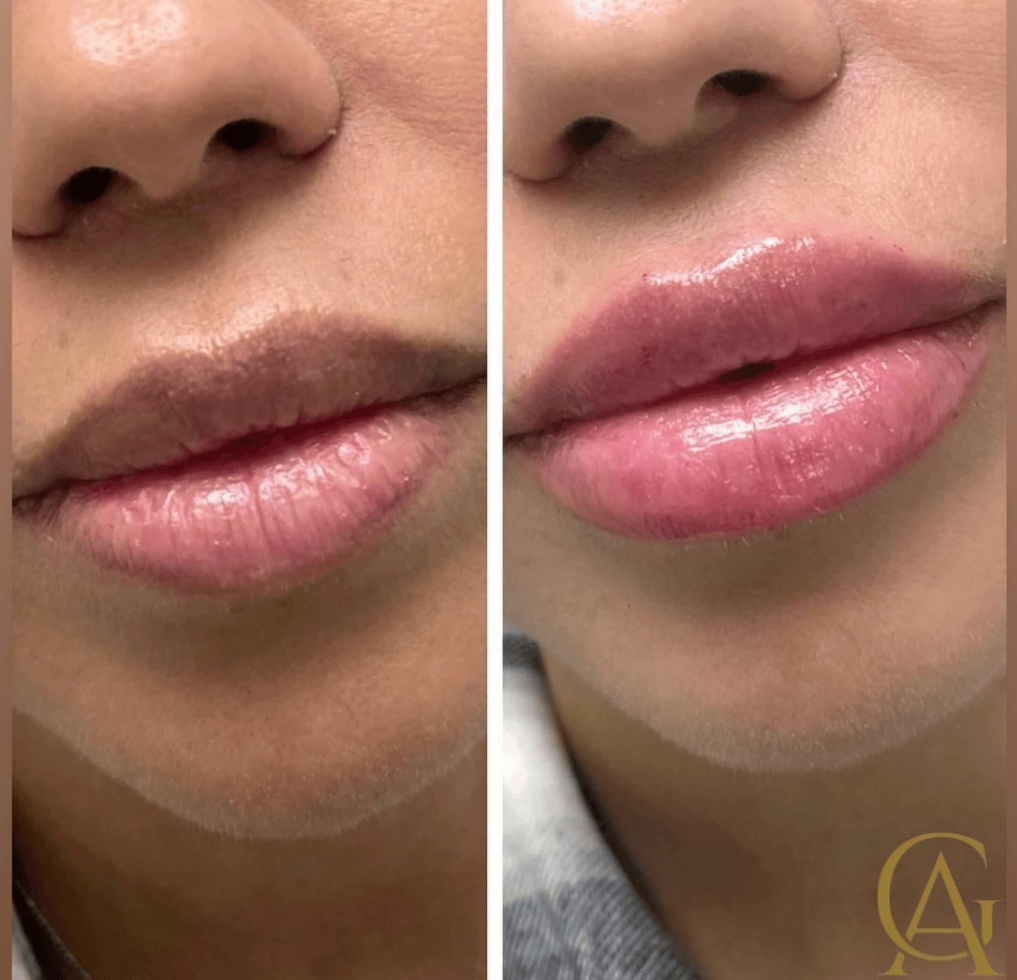 Lip Fillers Before & After Gallery - Patient 421283 - Image 1