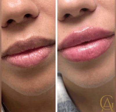 Lip Fillers Before & After Gallery - Patient 421283 - Image 1