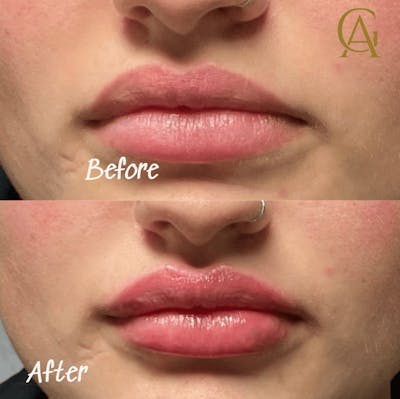 Lip Fillers Before & After Gallery - Patient 213241 - Image 1