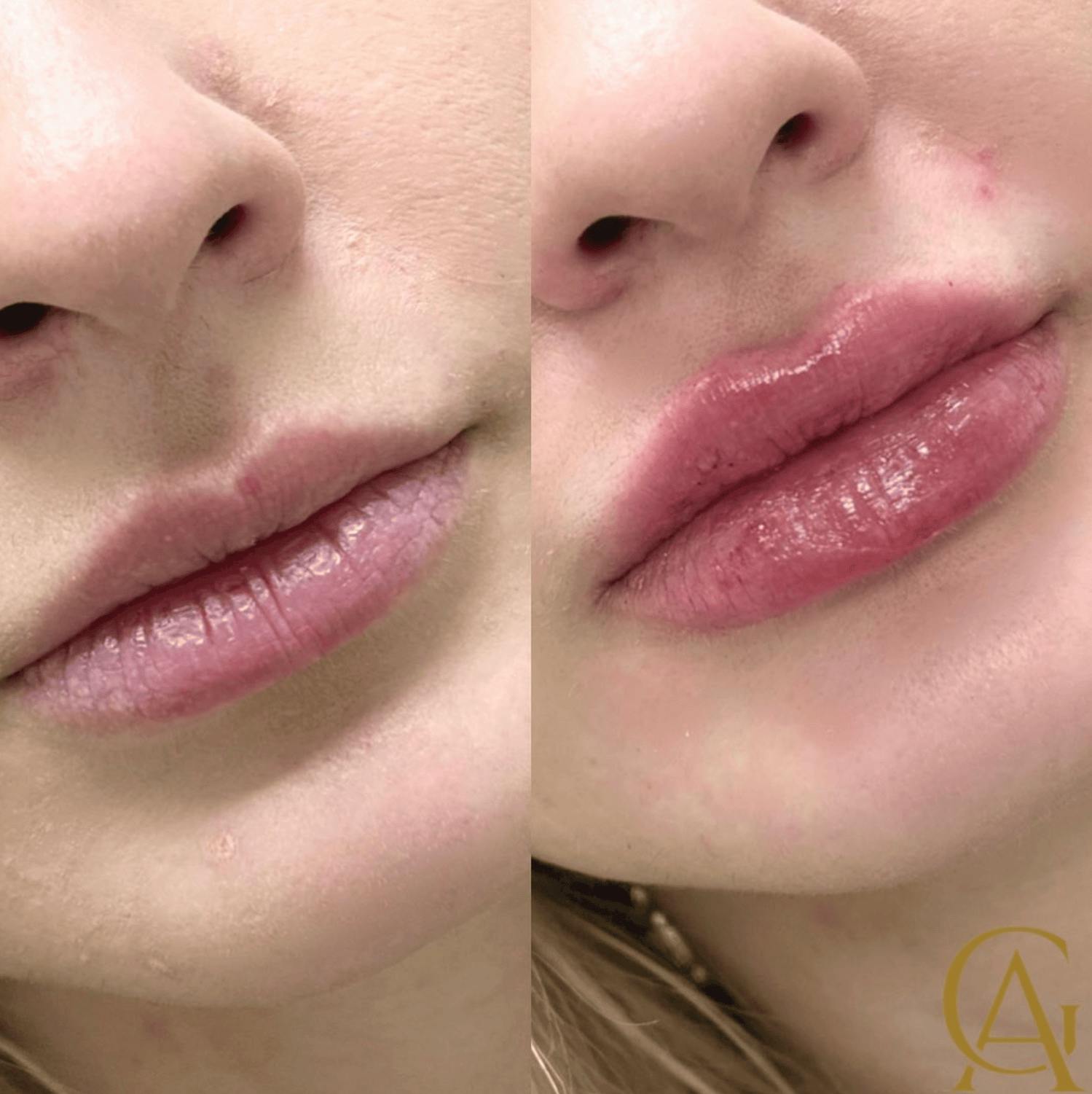 Lip Fillers Before & After Gallery - Patient 151255 - Image 1