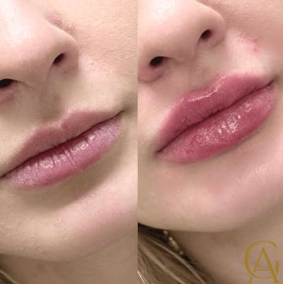 Lip Fillers Before & After Gallery - Patient 151255 - Image 1