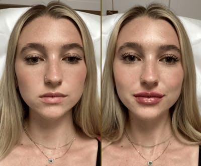 Lip Fillers Before & After Gallery - Patient 141877 - Image 1