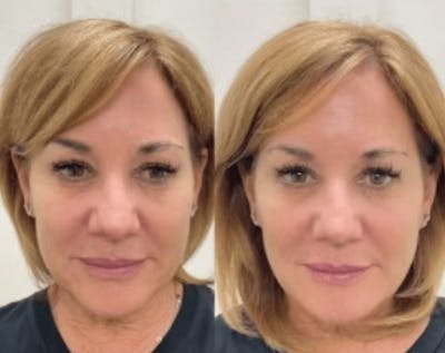 Liquid (Non-Surgical) Facelift Before & After Gallery - Patient 366448 - Image 1