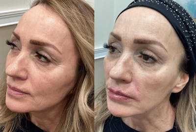 Liquid (Non-Surgical) Facelift Before & After Gallery - Patient 218939 - Image 1