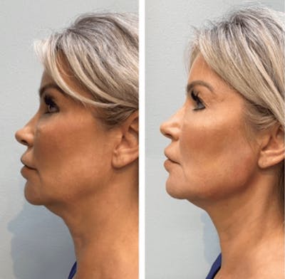Liquid (Non-Surgical) Facelift Before & After Gallery - Patient 262416 - Image 1