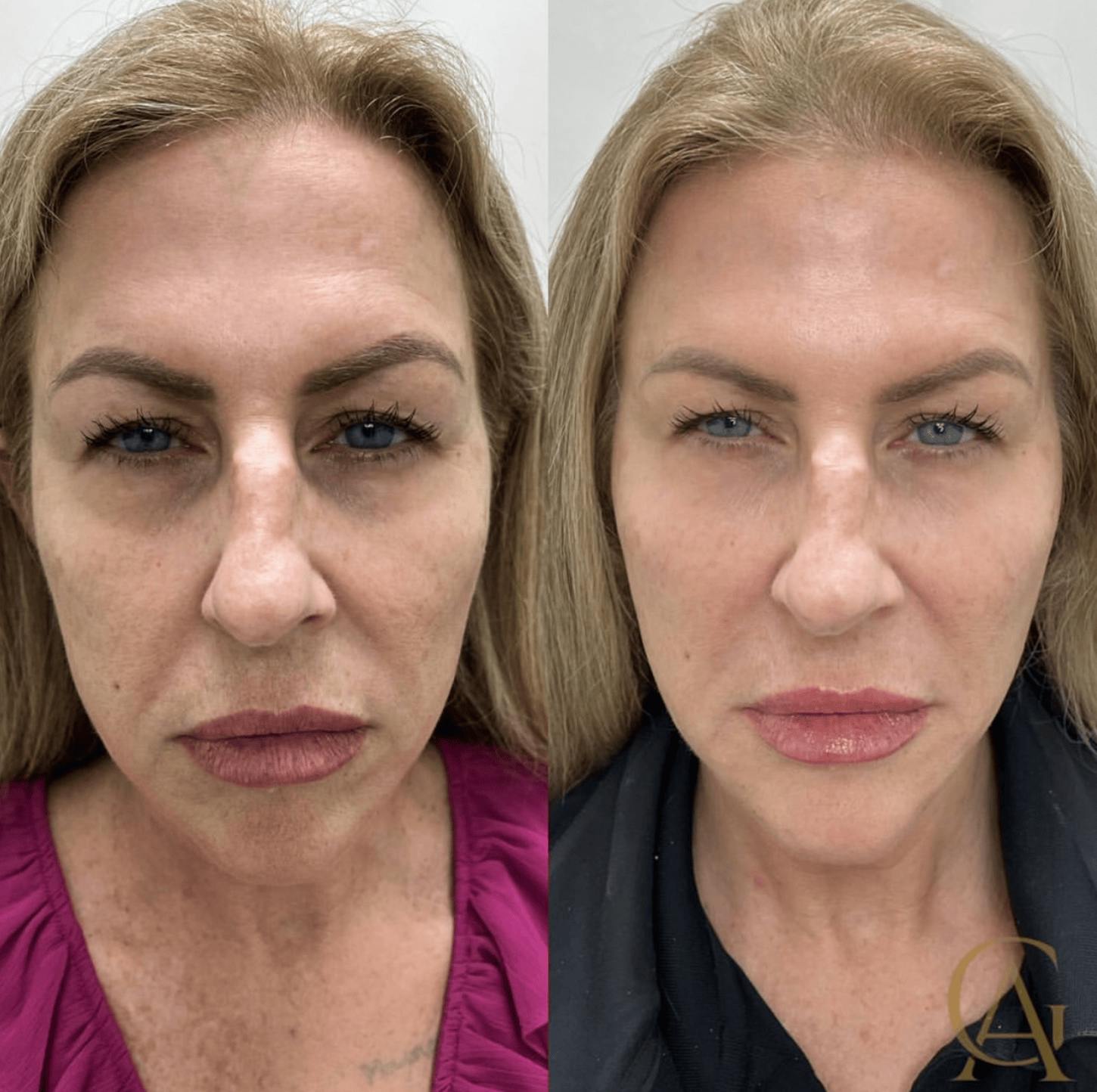 Liquid (Non-Surgical) Facelift Before & After Gallery - Patient 325083 - Image 1
