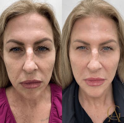 Liquid (Non-Surgical) Facelift Before & After Gallery - Patient 325083 - Image 1