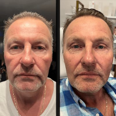 Liquid (Non-Surgical) Facelift Before & After Gallery - Patient 171040 - Image 1