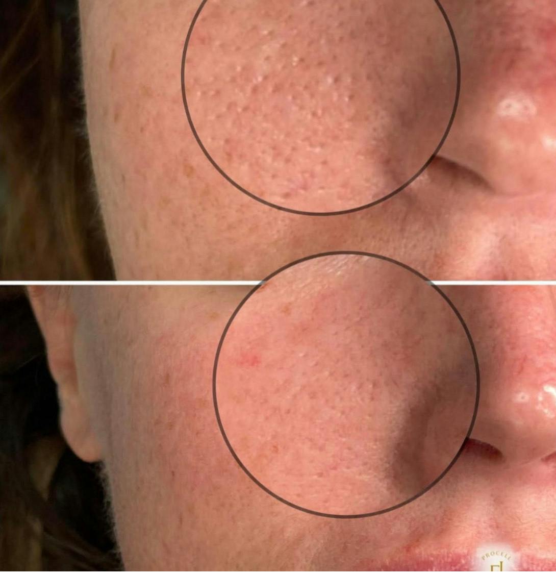 Micro-Channeling Before & After Gallery - Patient 286297 - Image 1
