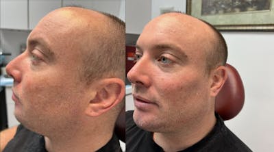 Liquid Chin & Jaw Contouring Before & After Gallery - Patient 359263 - Image 1