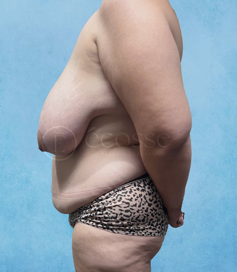 Abdominoplasty Before & After Gallery - Patient 376482 - Image 9