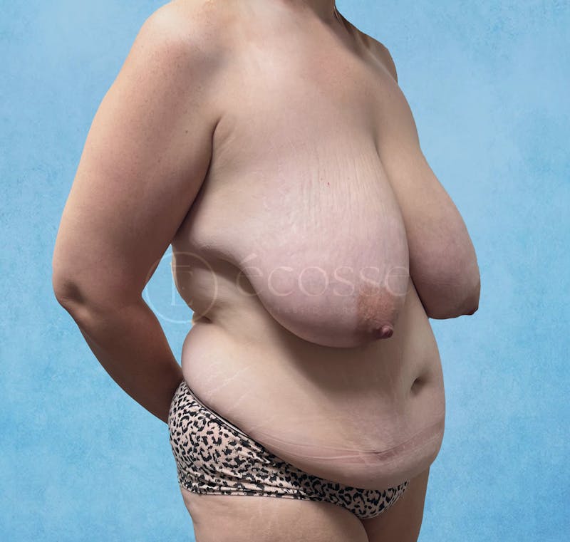 Abdominoplasty Before & After Gallery - Patient 376482 - Image 3