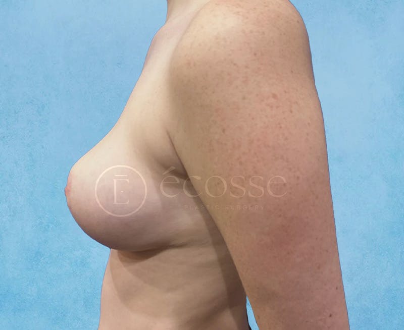 Breast Reduction Before & After Gallery - Patient 215039 - Image 10