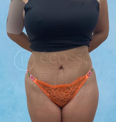 Abdominoplasty Before & After Gallery - Patient 297301 - Image 2