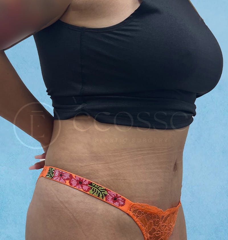 Abdominoplasty Before & After Gallery - Patient 297301 - Image 4